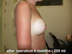 plastic-surgery-breast-augmentation 